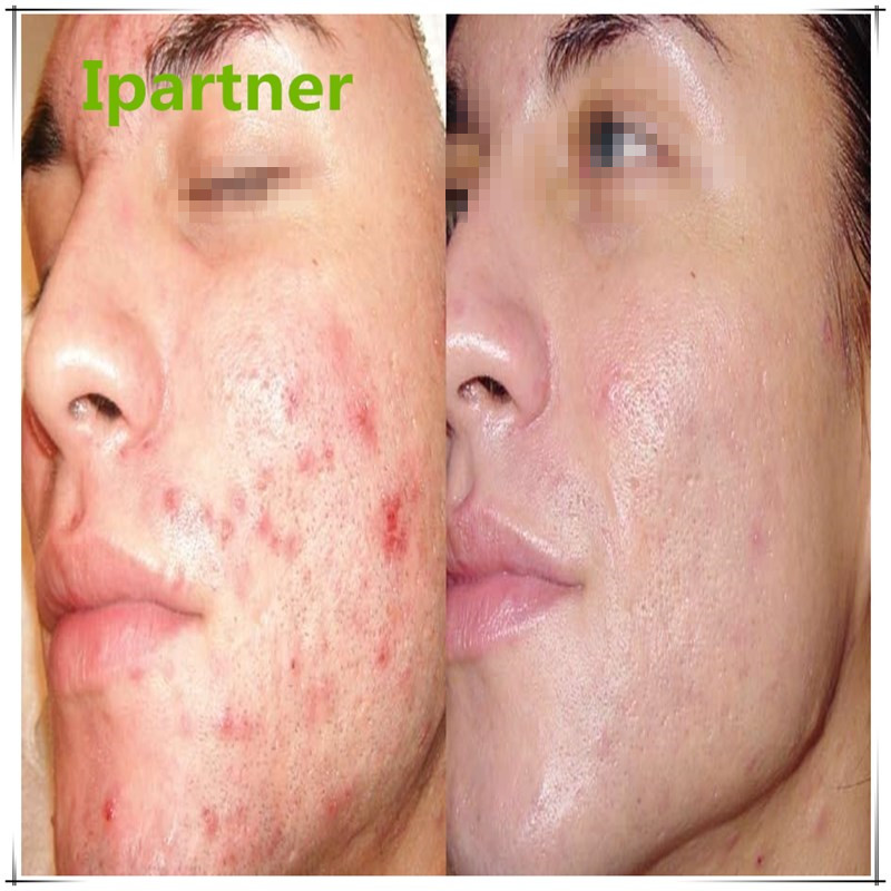 Hot prodej Derma Roller pro péči o pleť